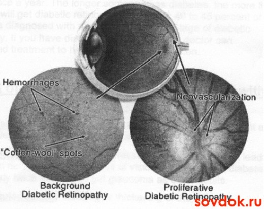 изменения сетчатки при ретинопатии