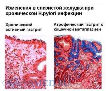 Изменения в слизистой желудка