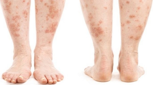 лечение дерматита ног