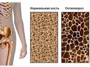  Нормальная кость, остеопороз