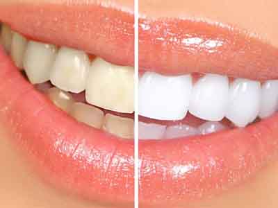 зубы до отбеливания и после