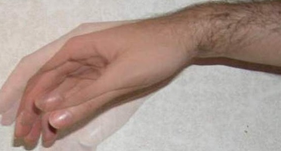 Тремор пальцев рук