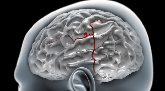 Операция аневризмы сосудов головного мозга