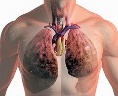 Симптомы рака легких