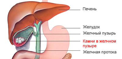 Схематичное изображение локализации заболевания