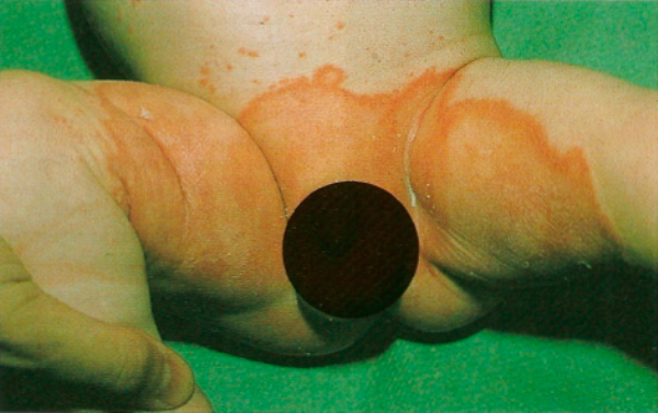 кандидозный дерматит у детей
