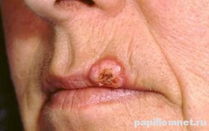 Фото кератоакантомы на лице человека
