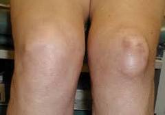 Лечение кисты коленного сустава