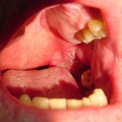 Лечение кисты в горле