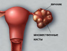 поликистоз