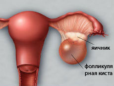 фолликулярная киста яичника