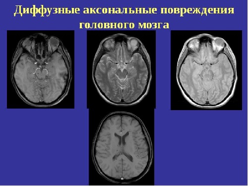 Диффузно-аксональное повреждение головного мозга