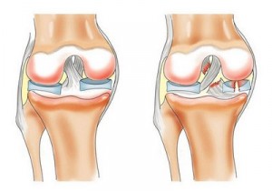 разрыв связки коленного сустава