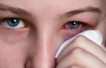 Воспаление глаза (конъюнктивит)