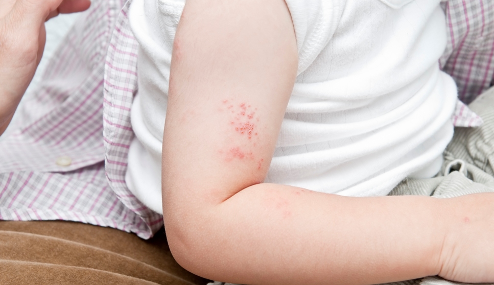Самые распространенные кожные заболевания у детей
