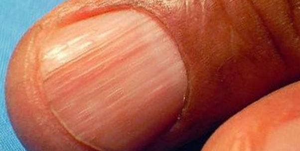 проявление болезни на ногтях