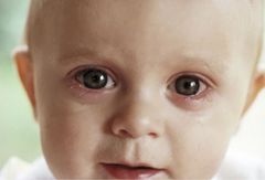 Покраснение глаза у ребенка