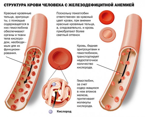 Кровь при анемии обладает характерной бледностью