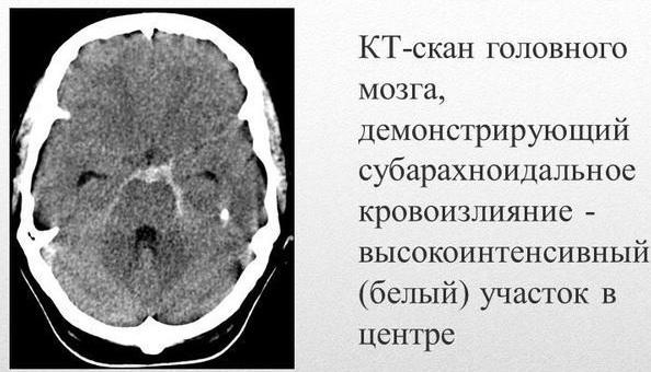 Субарахноидальное кровоизлияние в мозг