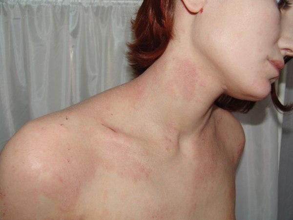 аллергия симптомы лечение