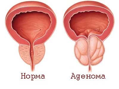 аденома простаты