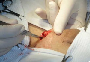 Лечение операция варикоцеле фото