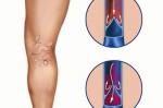 Варикозная болезнь: как ноги могут стать проблемой