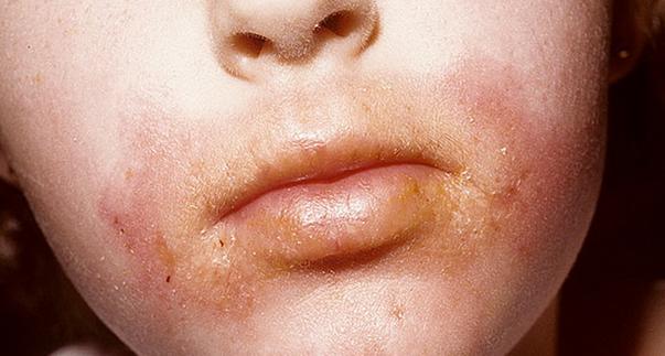 симптомы дерматита на лице
