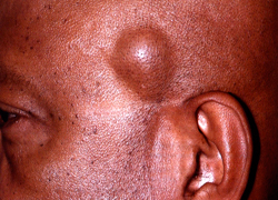 Фото жировика, который образовался на лице человека
