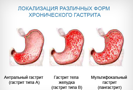 Локализация гастрита
