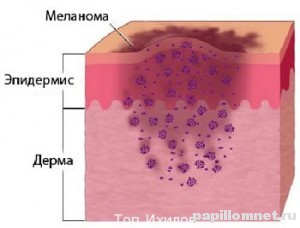 Схема развития меланомы в коже