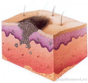 Схематичное изображение расположения меланомы на коже