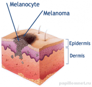 Схема проявления меланомы на участке дермы