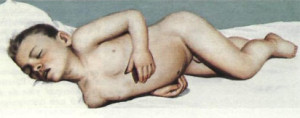 менингит