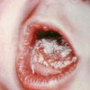 Молочница у детей во рту: причины и лечение
