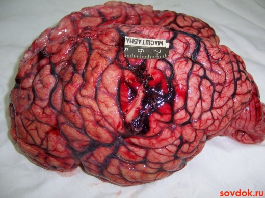 мозг человека - инсульт