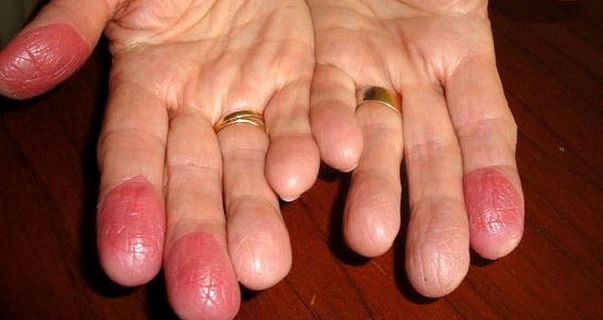 контактный дерматит на пальцах