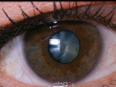  помутнение хрусталика, катаракта