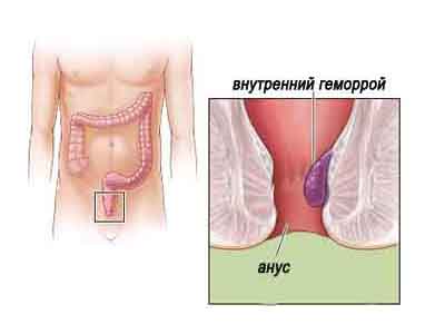 внутренний геморрой