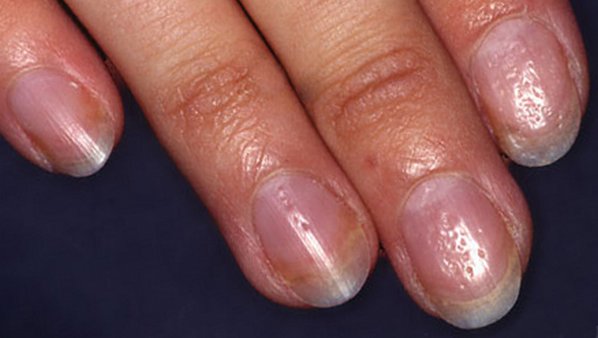 причины ногтевого псориаза