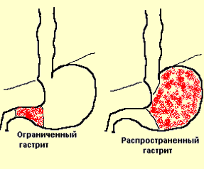 Очищение при гастрите