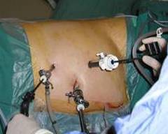 Эндоскопическая операция по удалению кисты