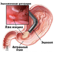 Определение кислотности желудка