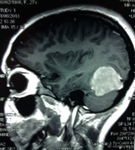 Опухоль головного мозга фото