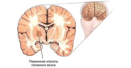 Симптомы опухоли мозга