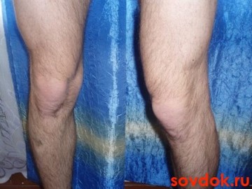 первичный  остоеоартроз  коленных  суставов