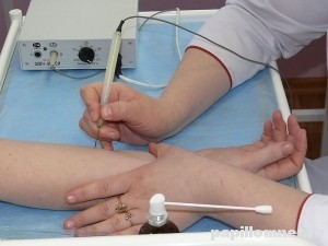 Изображение применения электрокоагуляции для удаления папилломы на руке