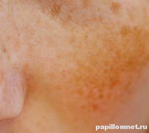 Проявления пигментных пятен на коже лица