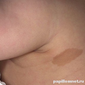 Единичное пигментное пятно на теле у ребенка