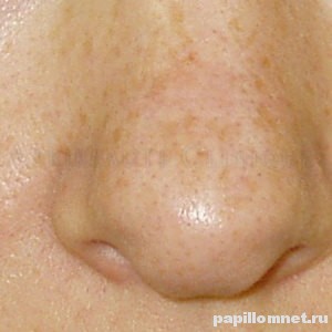 Фото пигментных пятен на коже носа человека